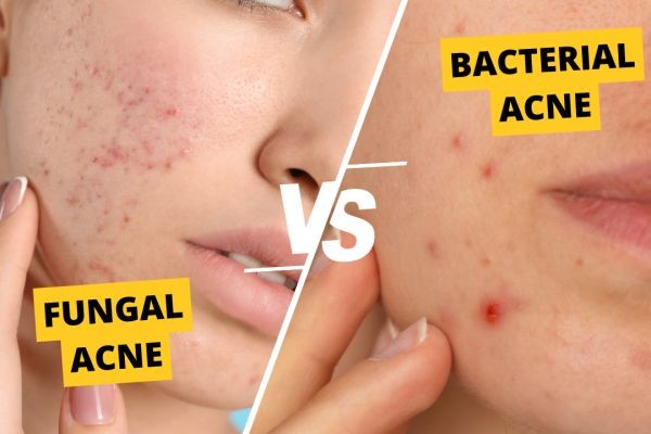 Bacterial vs Fungal Skin Infection: Know the Differences