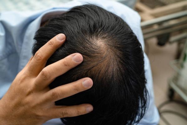 Can Hair Loss Treatment Strengthen Weak Hair?