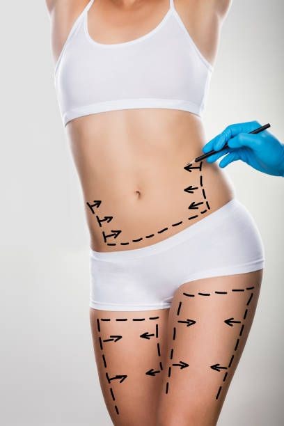 Liposuction Procedure Guide for Understanding Targeted Fat Reduction