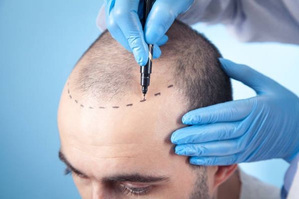 Hair Loss Solutions in Riyadh: From PRP to Transplants