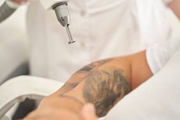 Laser Tattoo Removal in Riyadh for Multicolored Ink