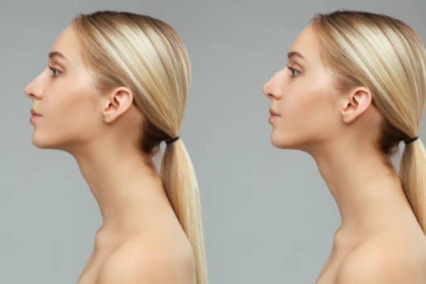 Rhinoplasty Care and Consultations in Riyadh