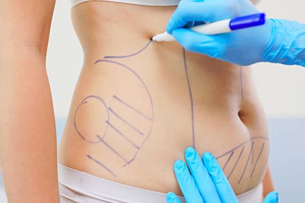 Liposuction in Riyadh: What Makes a Natural-Looking Result?