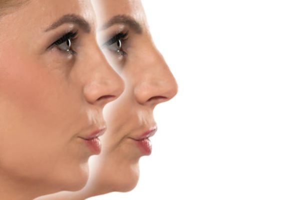 Hiko Nose Lift Aftercare Costs: What to Budget For