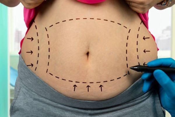 Abdominoplasty and Tummy Tuck: Exploring the Surgical Process