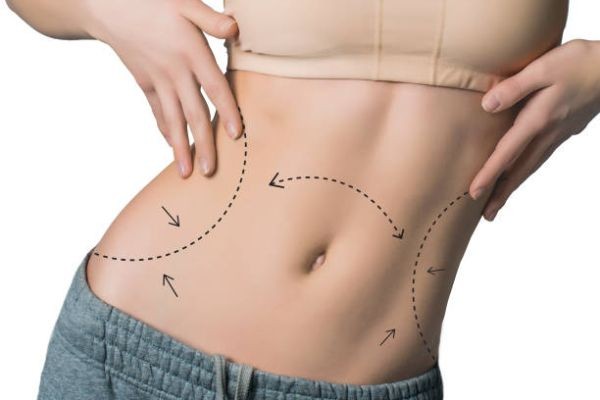 What Makes Someone a Suitable Liposuction Candidate in Riyadh?