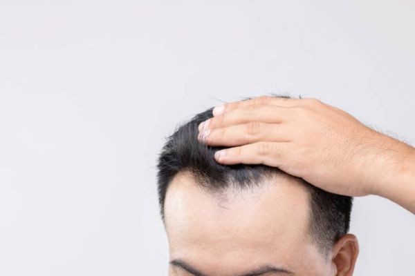 PRP Hair Treatment in Riyadh for Men Experiencing Hair Loss