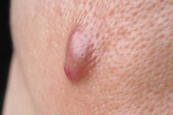 Riyadh Clinics: Sebaceous Cyst Removal Costs