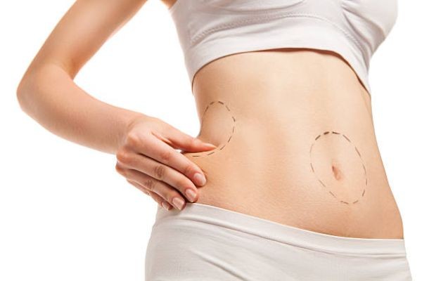What Makes Liposuction Different From Weight Loss?
