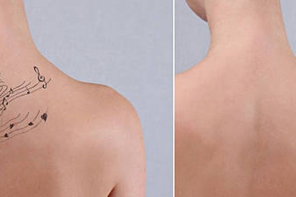 A Guide to Tattoo Removal Clinics in Riyadh